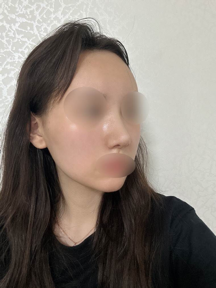 수술후기이미지