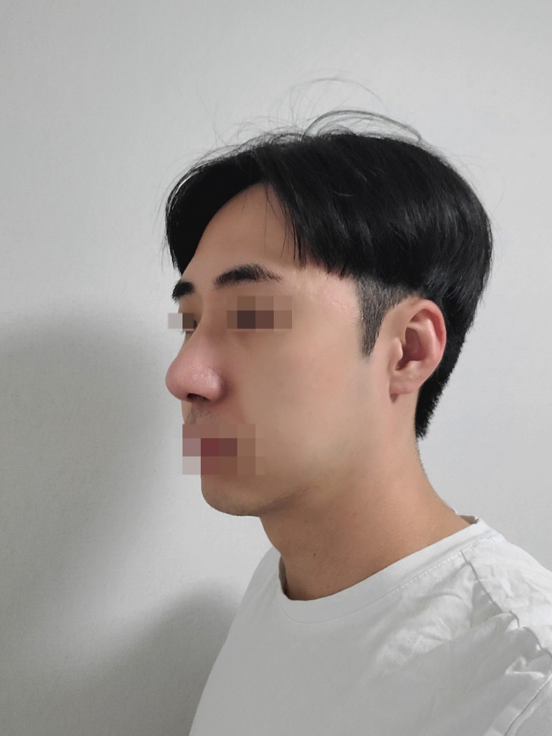 수술후기이미지