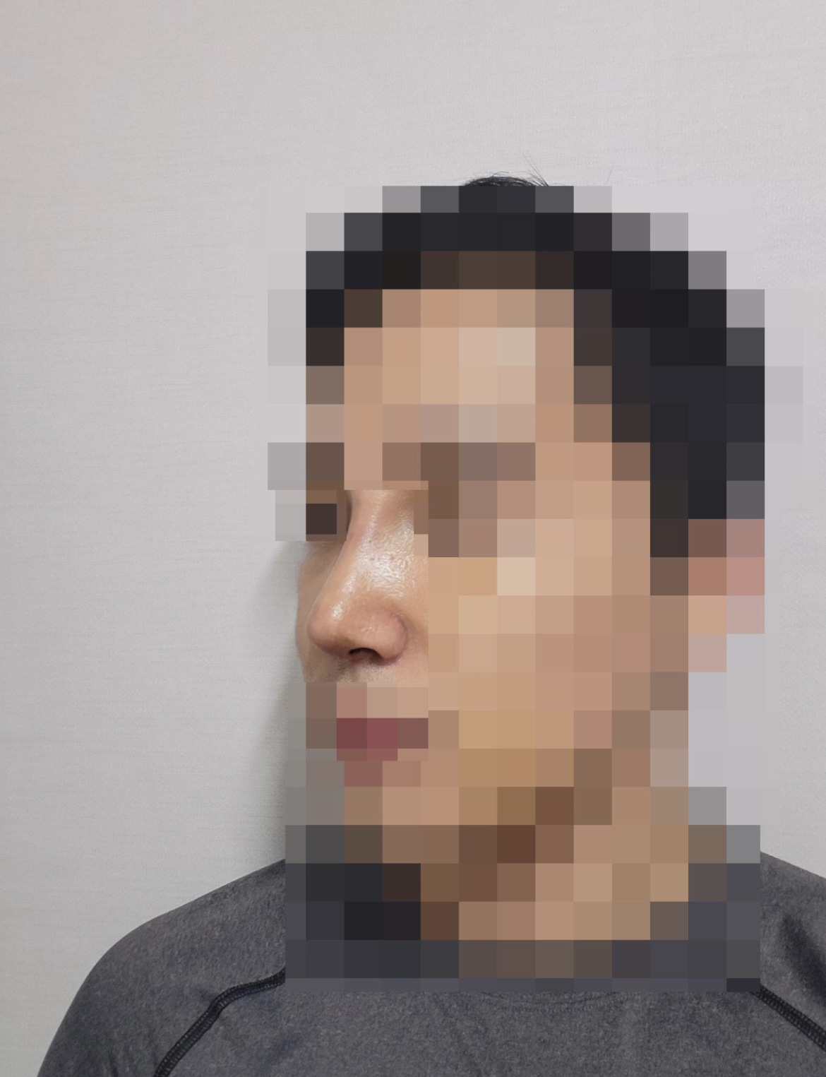 수술후기이미지