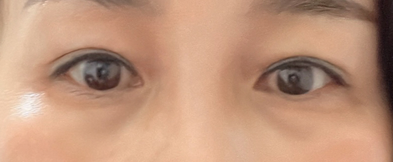 수술후기이미지