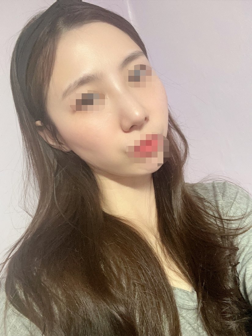 수술후기이미지