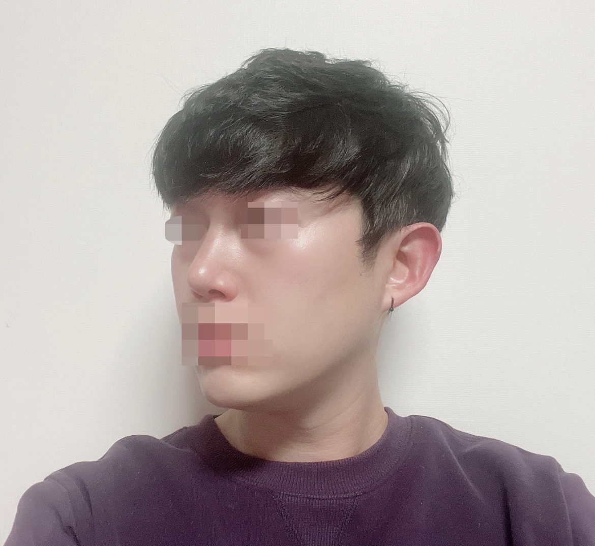 수술후기이미지