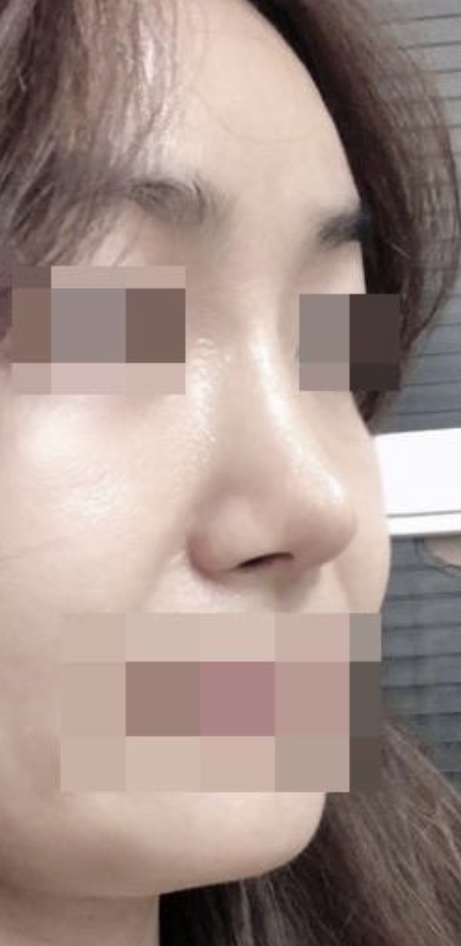 수술후기이미지