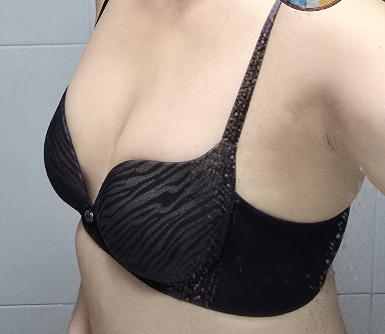 수술후기이미지