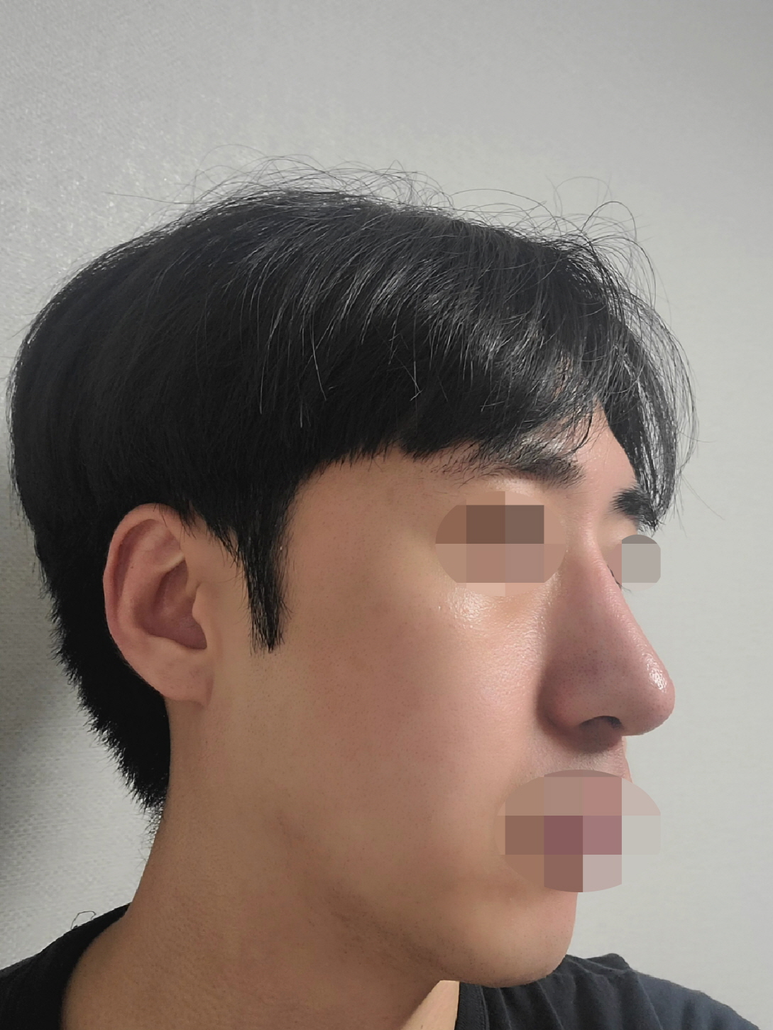 수술후기이미지