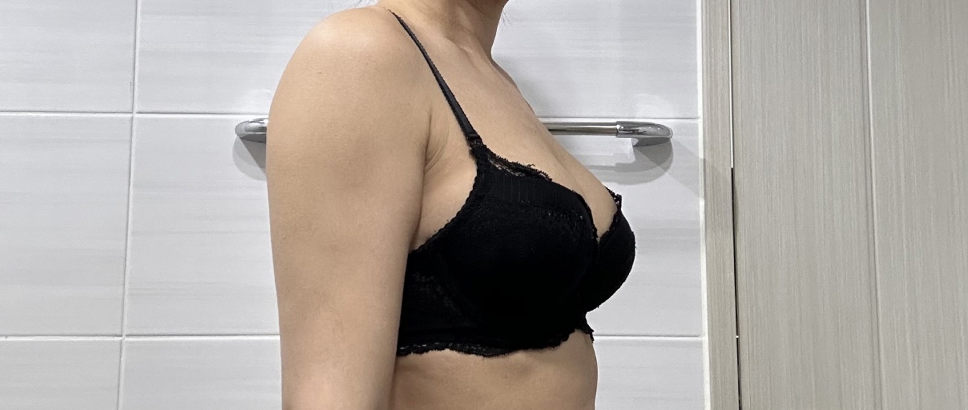 수술후기이미지