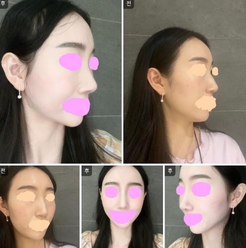 수술후기이미지