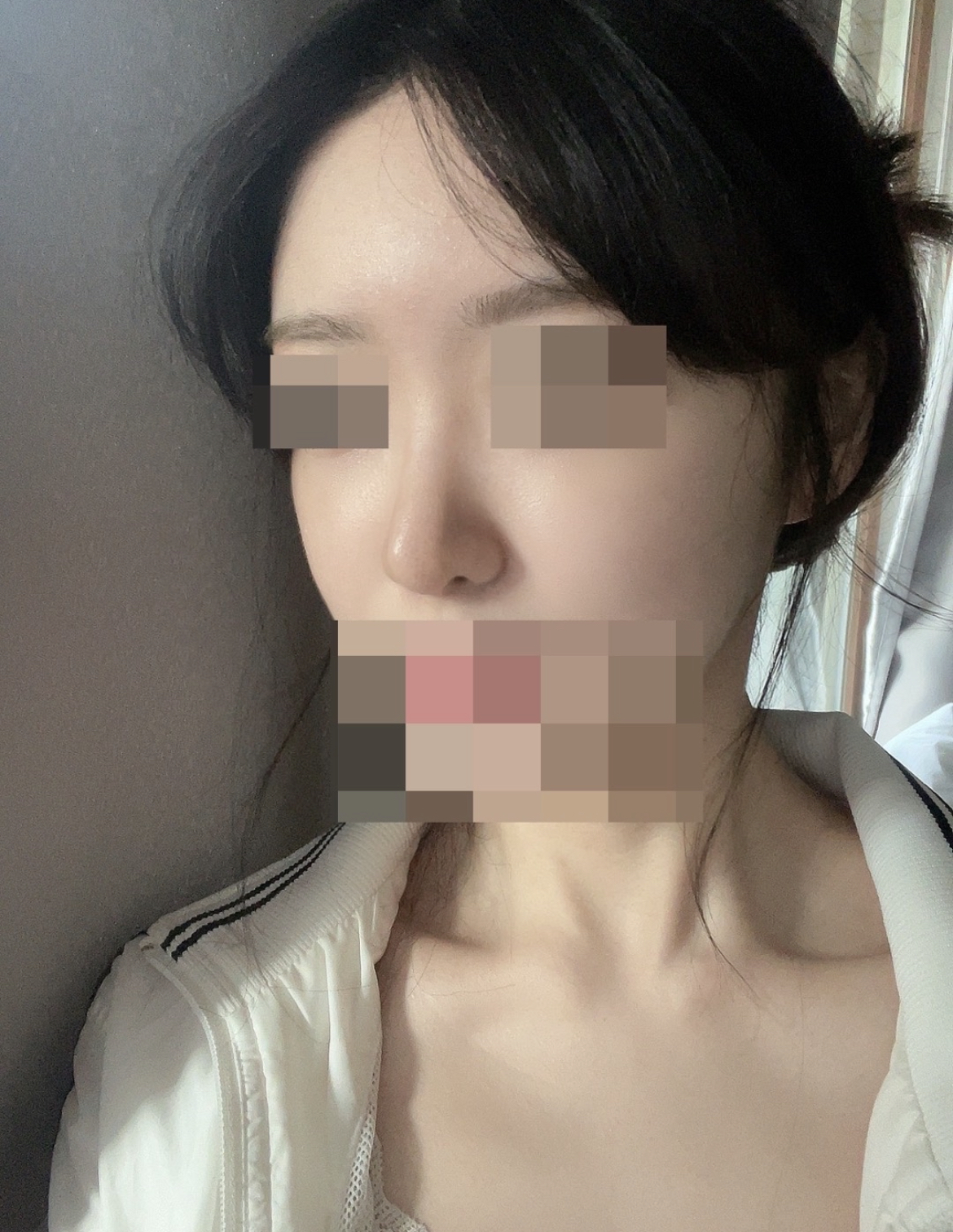 수술후기이미지