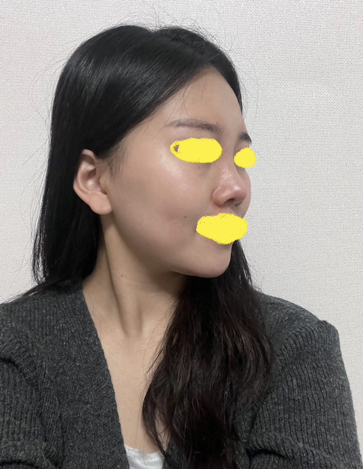 수술후기이미지