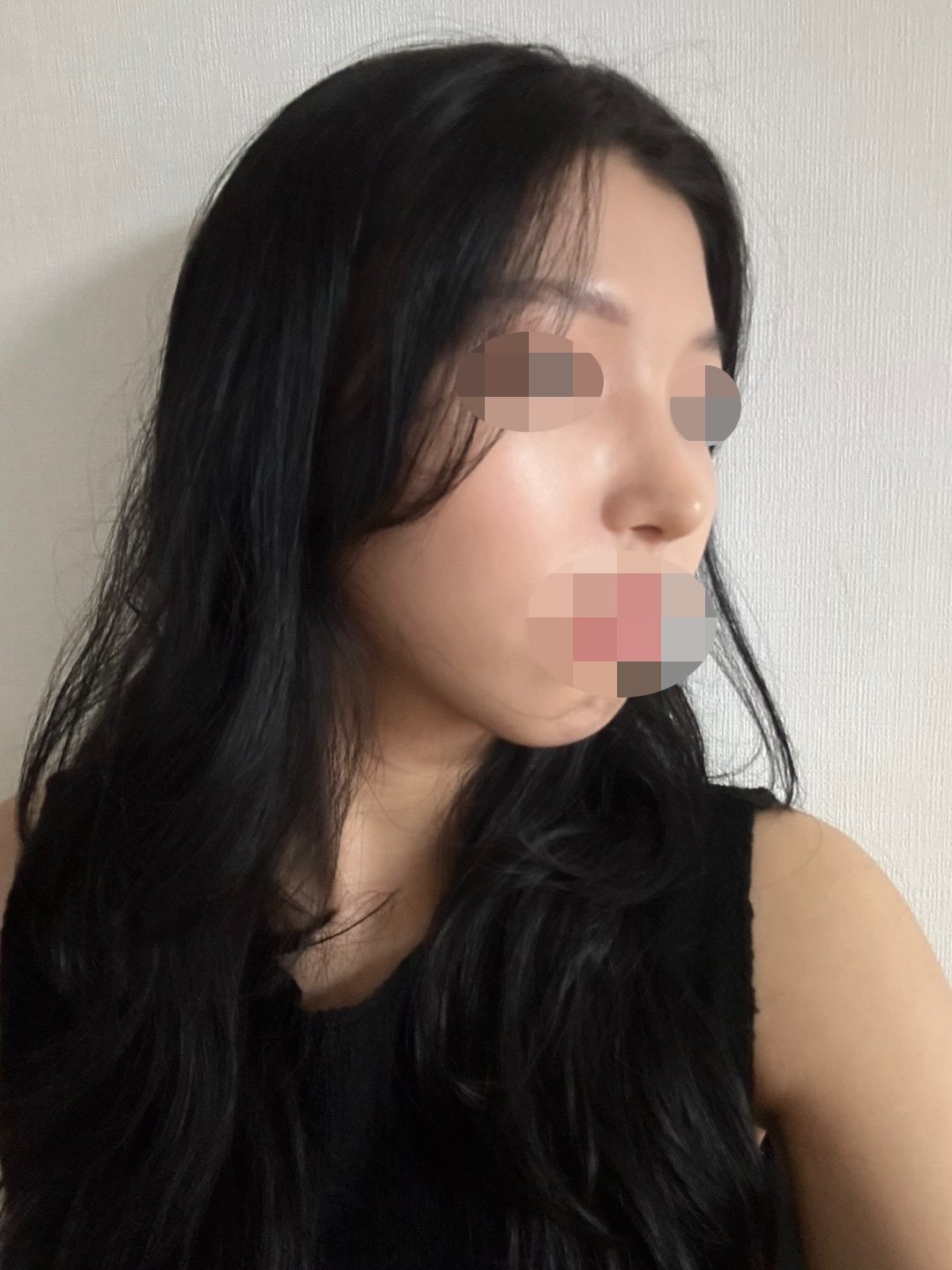 수술후기이미지