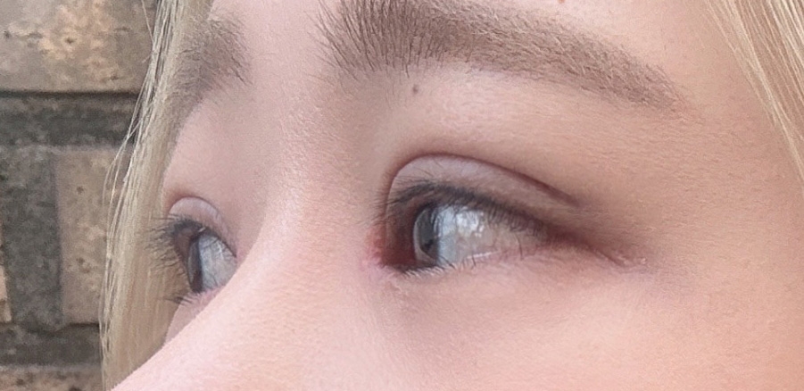 수술후기이미지