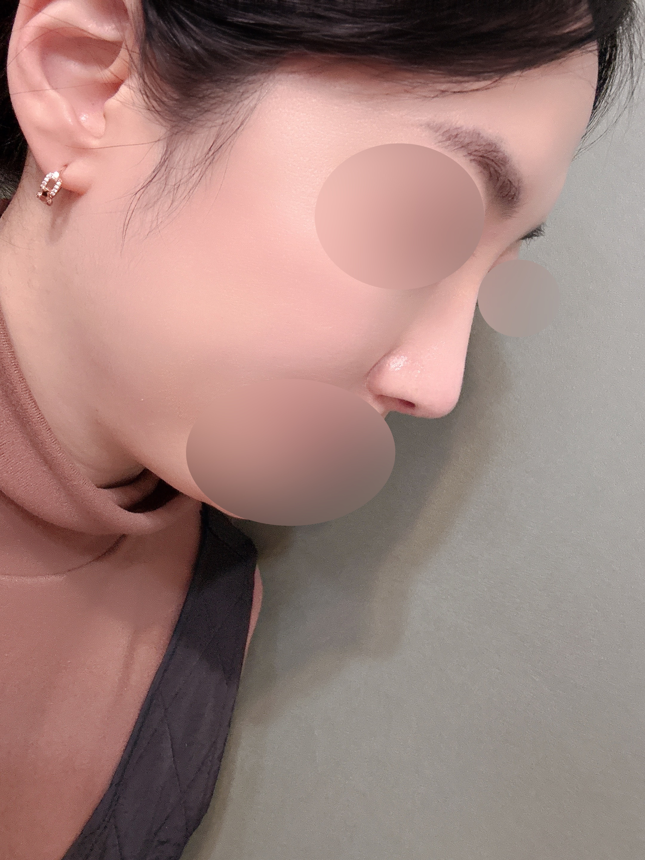 수술후기이미지