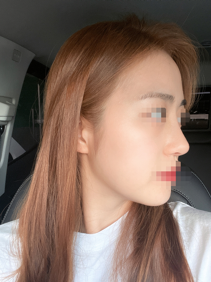 수술후기이미지