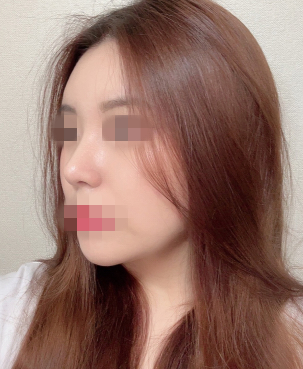 수술후기이미지