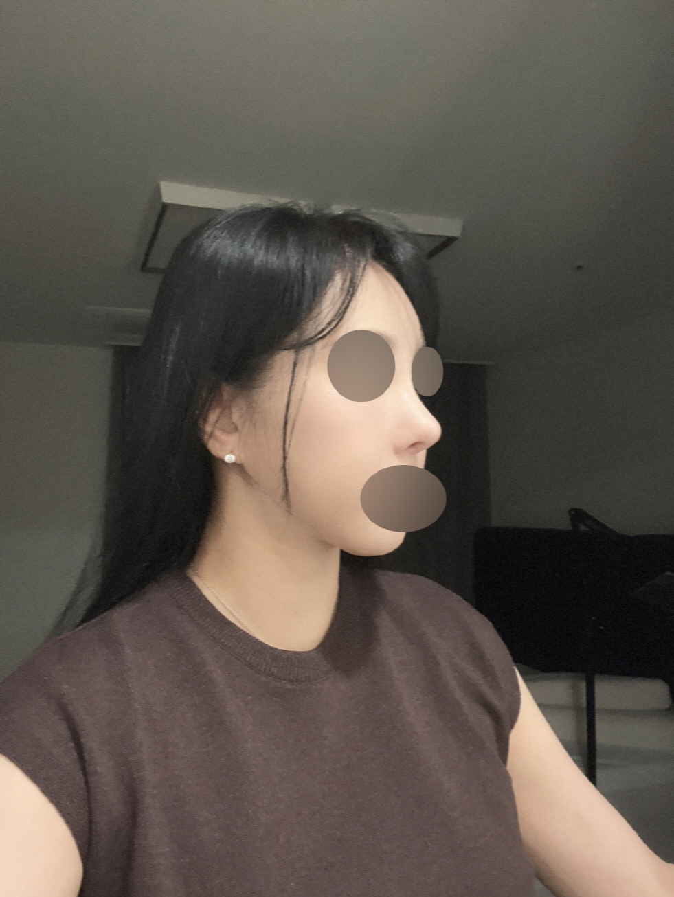 수술후기이미지