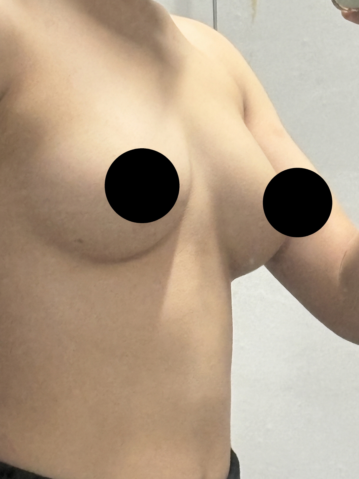 수술후기이미지