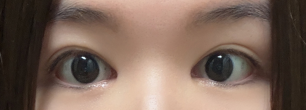 수술후기이미지