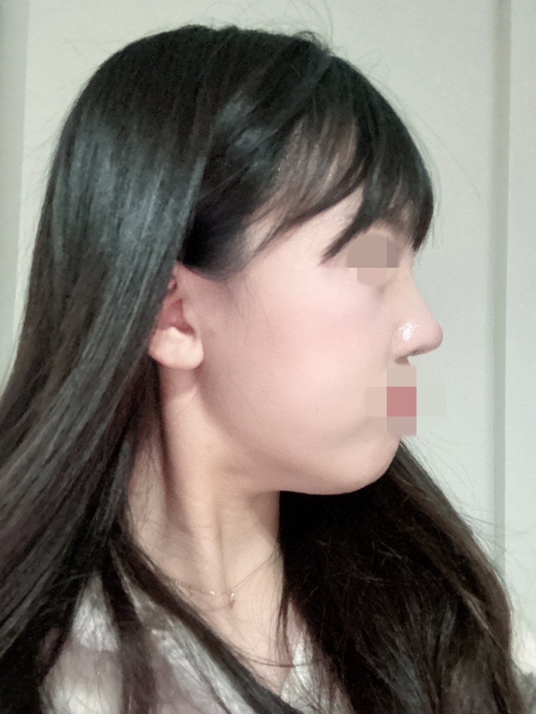 수술후기이미지