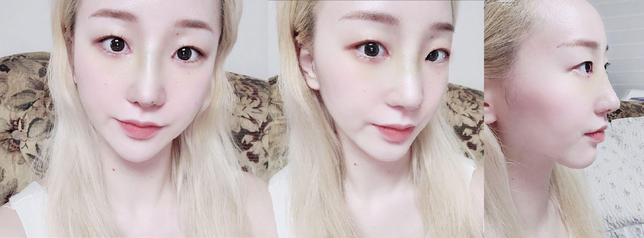 수술후기이미지