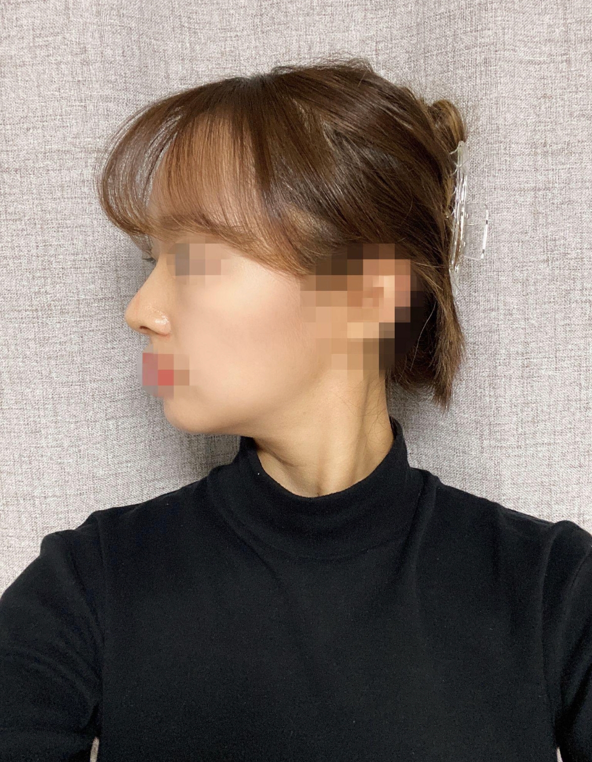 수술후기이미지