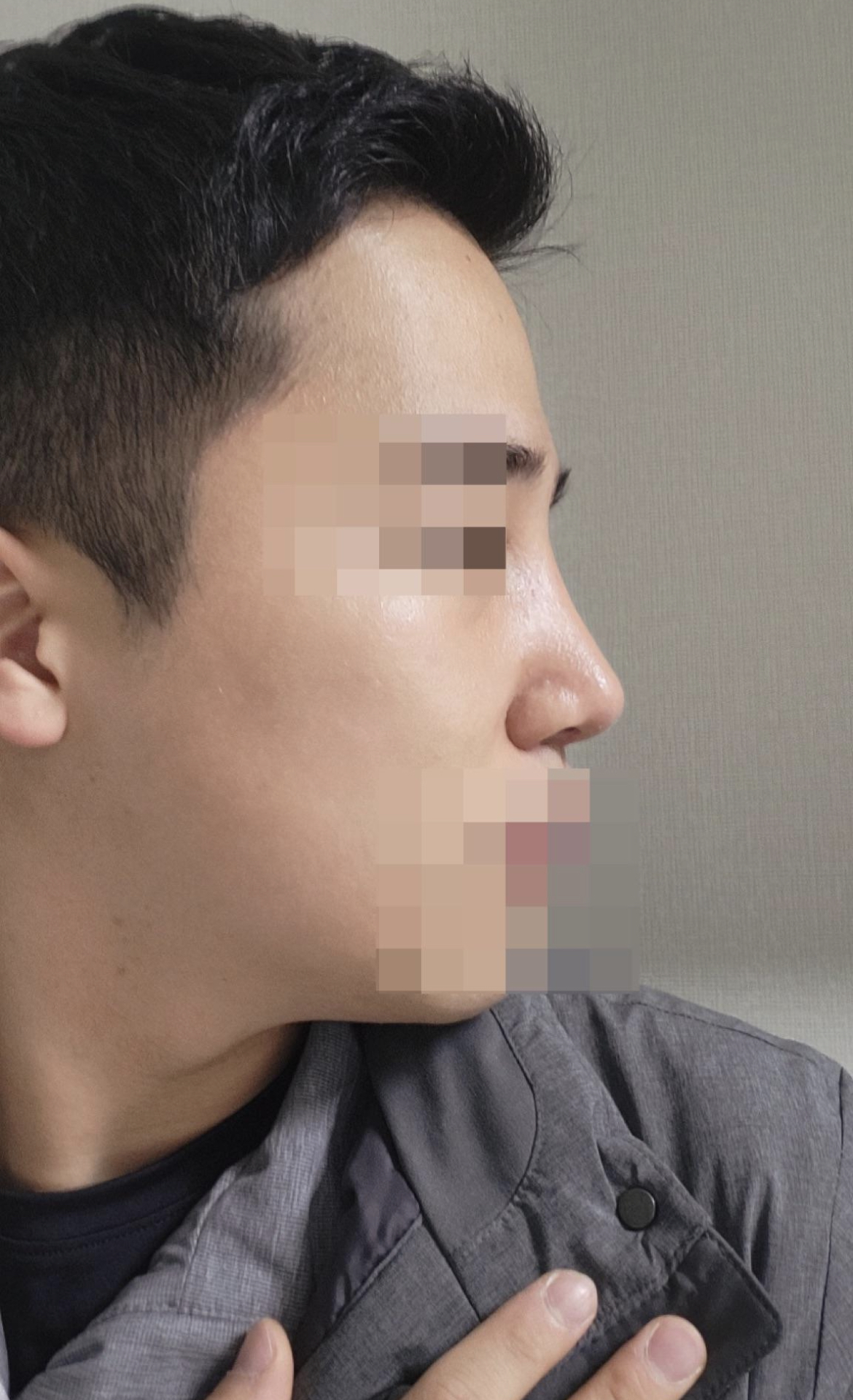 수술후기이미지