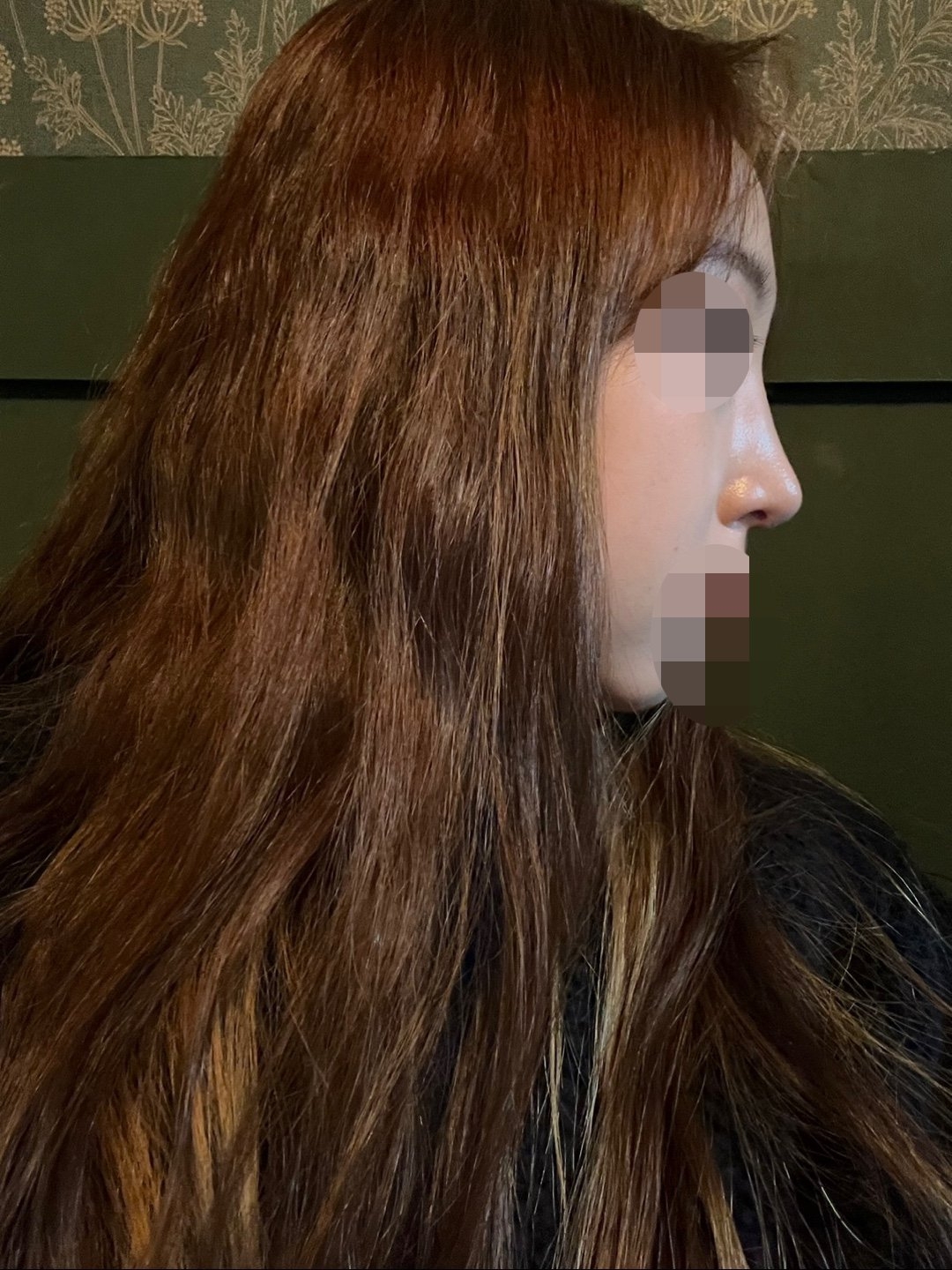 수술후기이미지