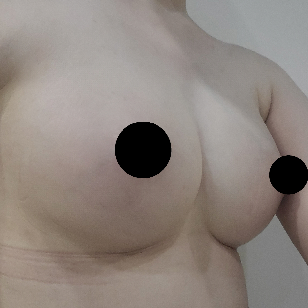 수술후기이미지