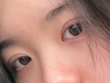 수술후기이미지