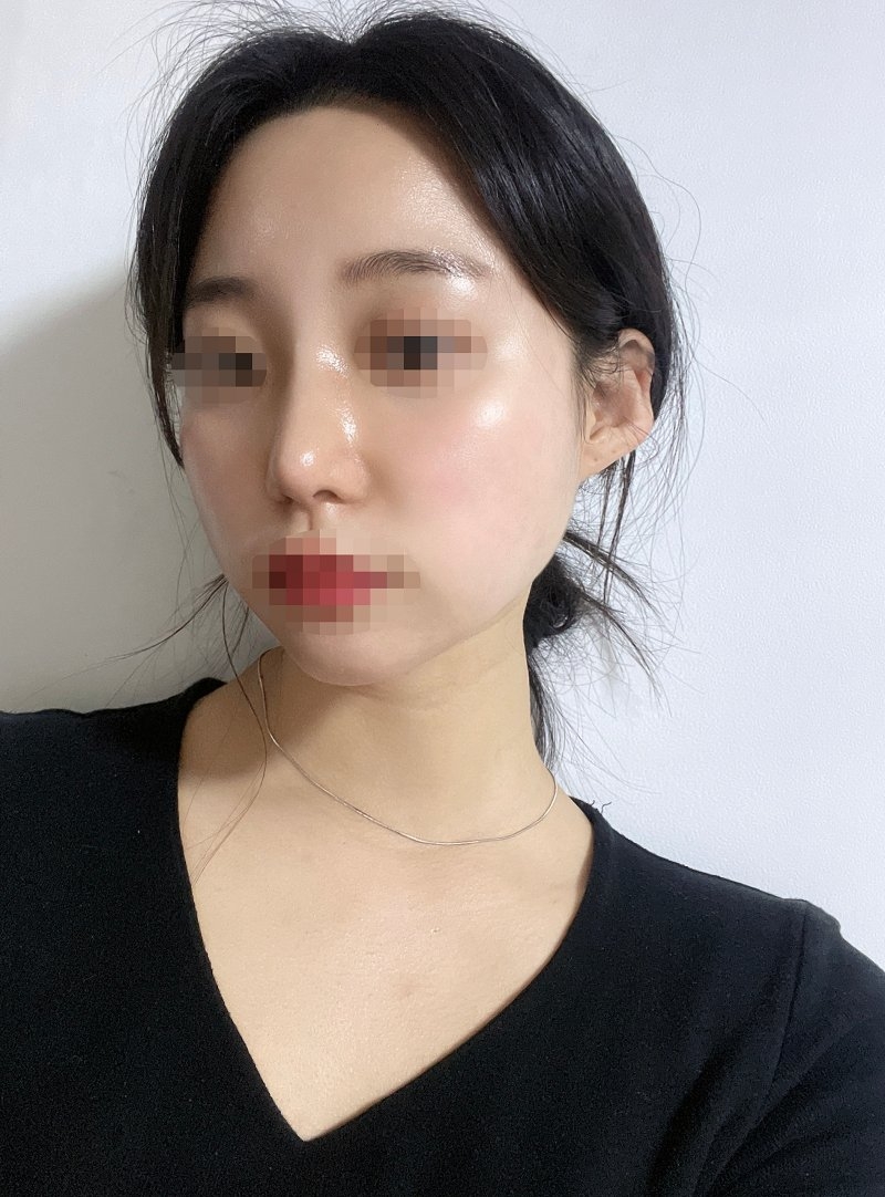 수술후기이미지