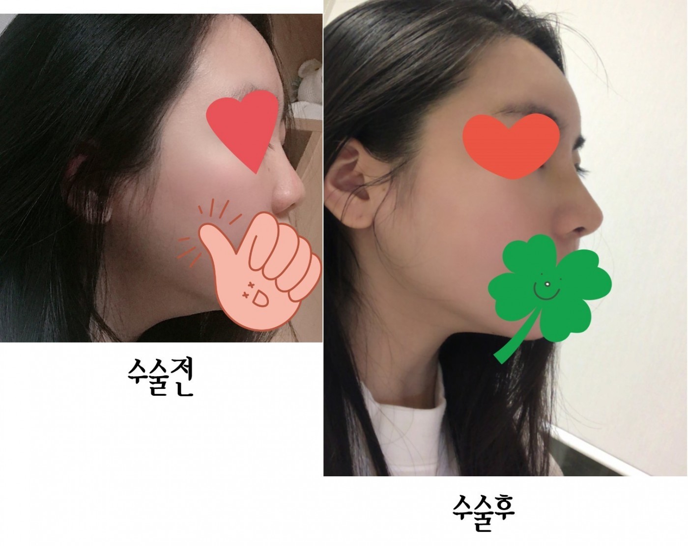 수술후기이미지