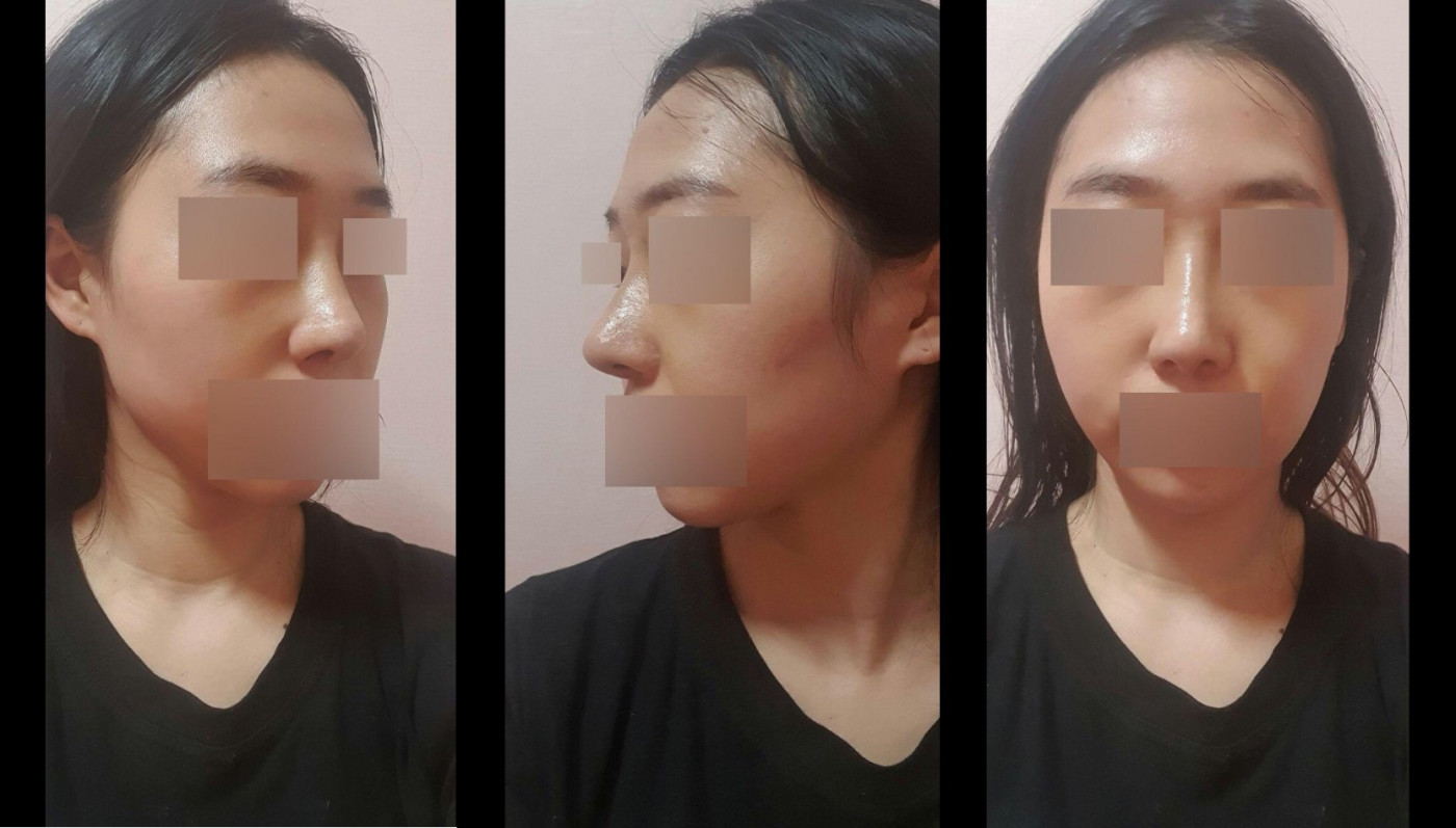 수술후기이미지