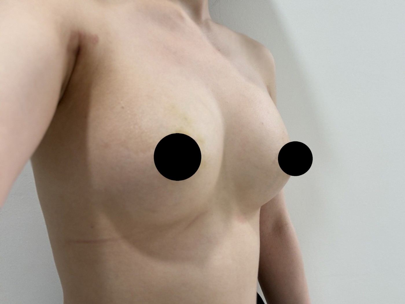 수술후기이미지