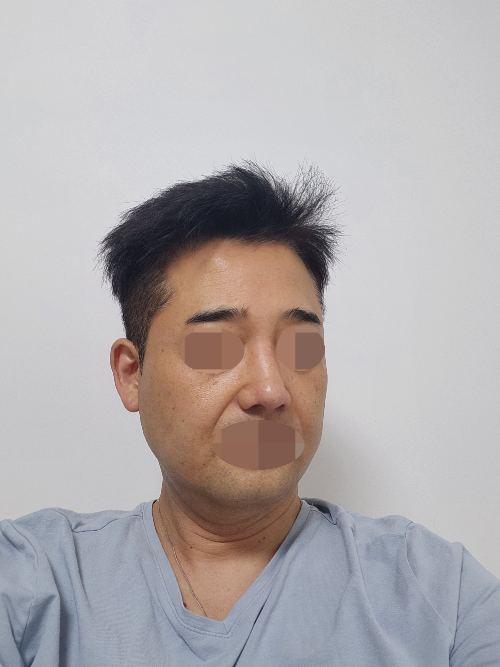 수술후기이미지