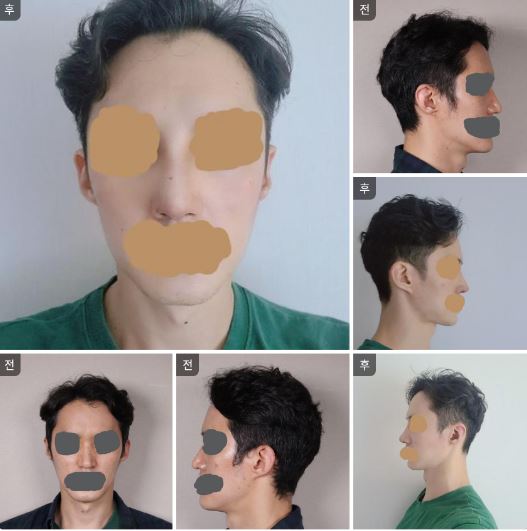 수술후기이미지