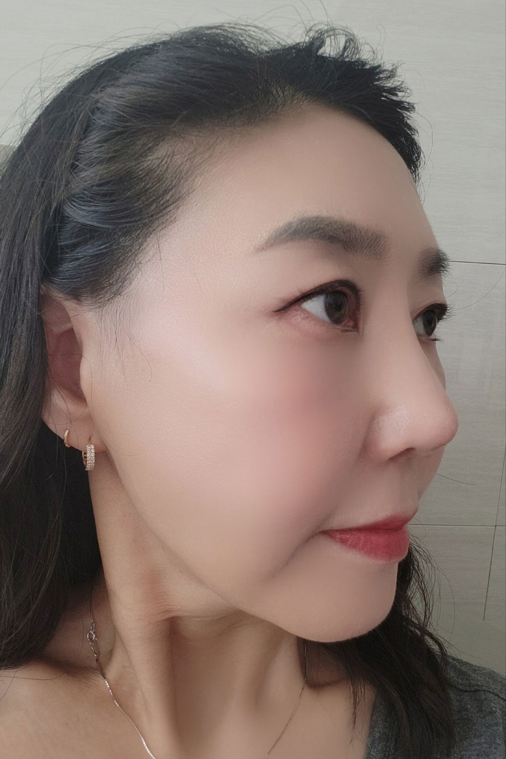 수술후기이미지