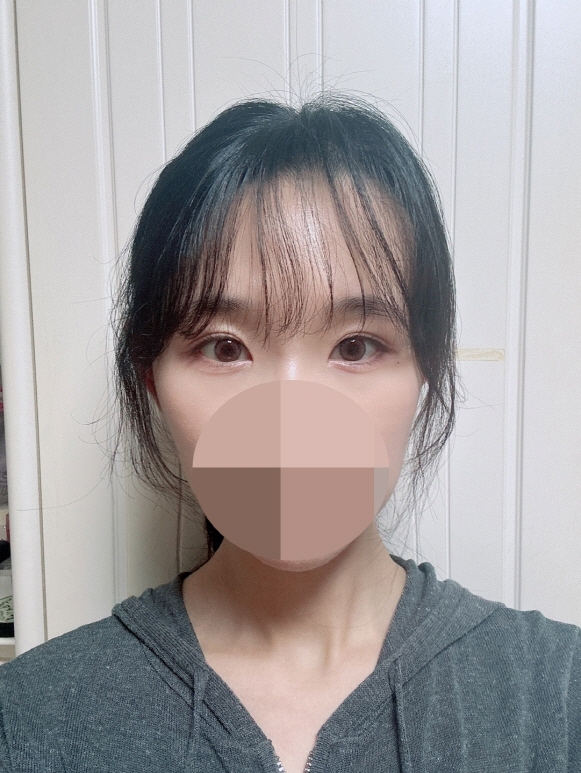 수술후기이미지