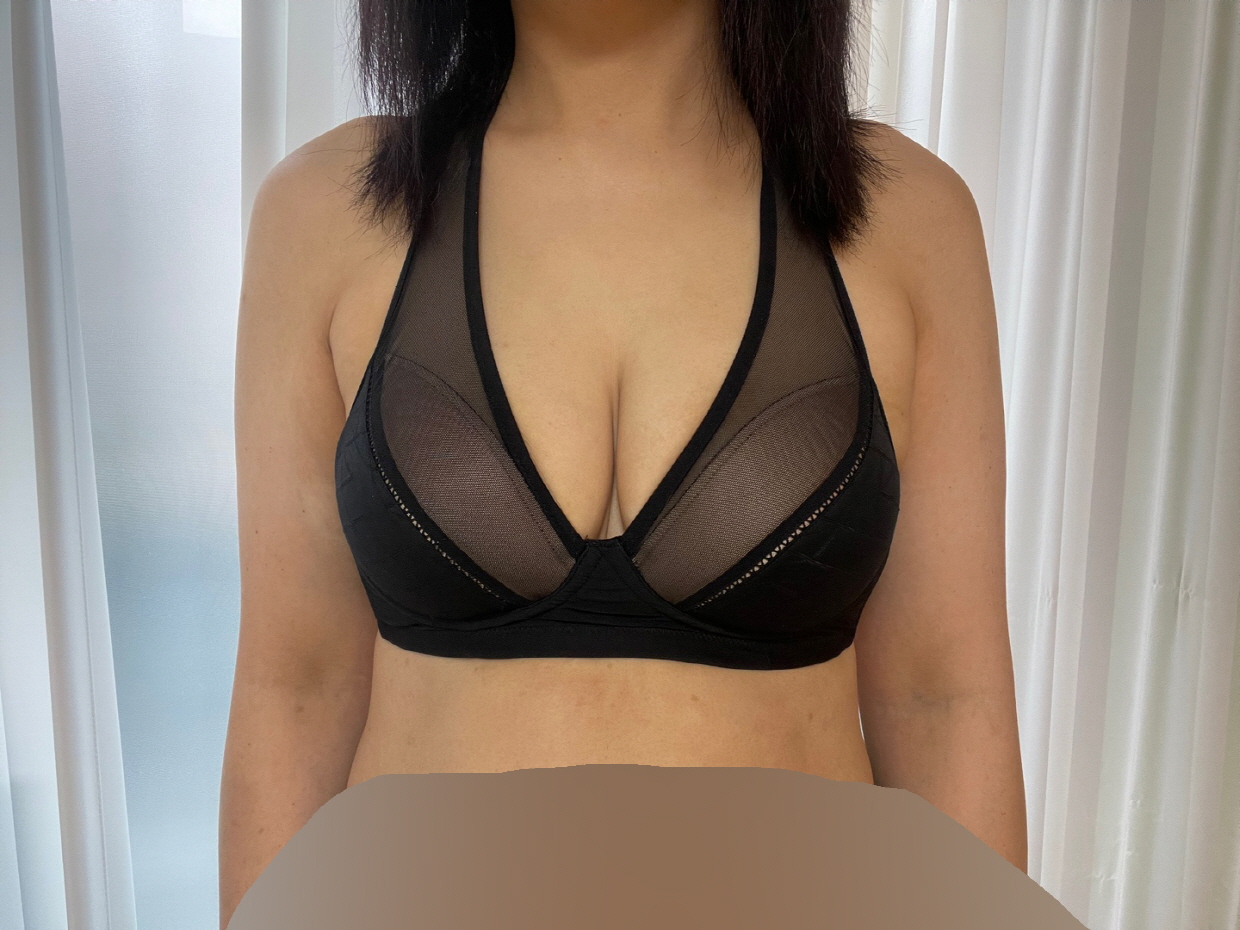 수술후기이미지