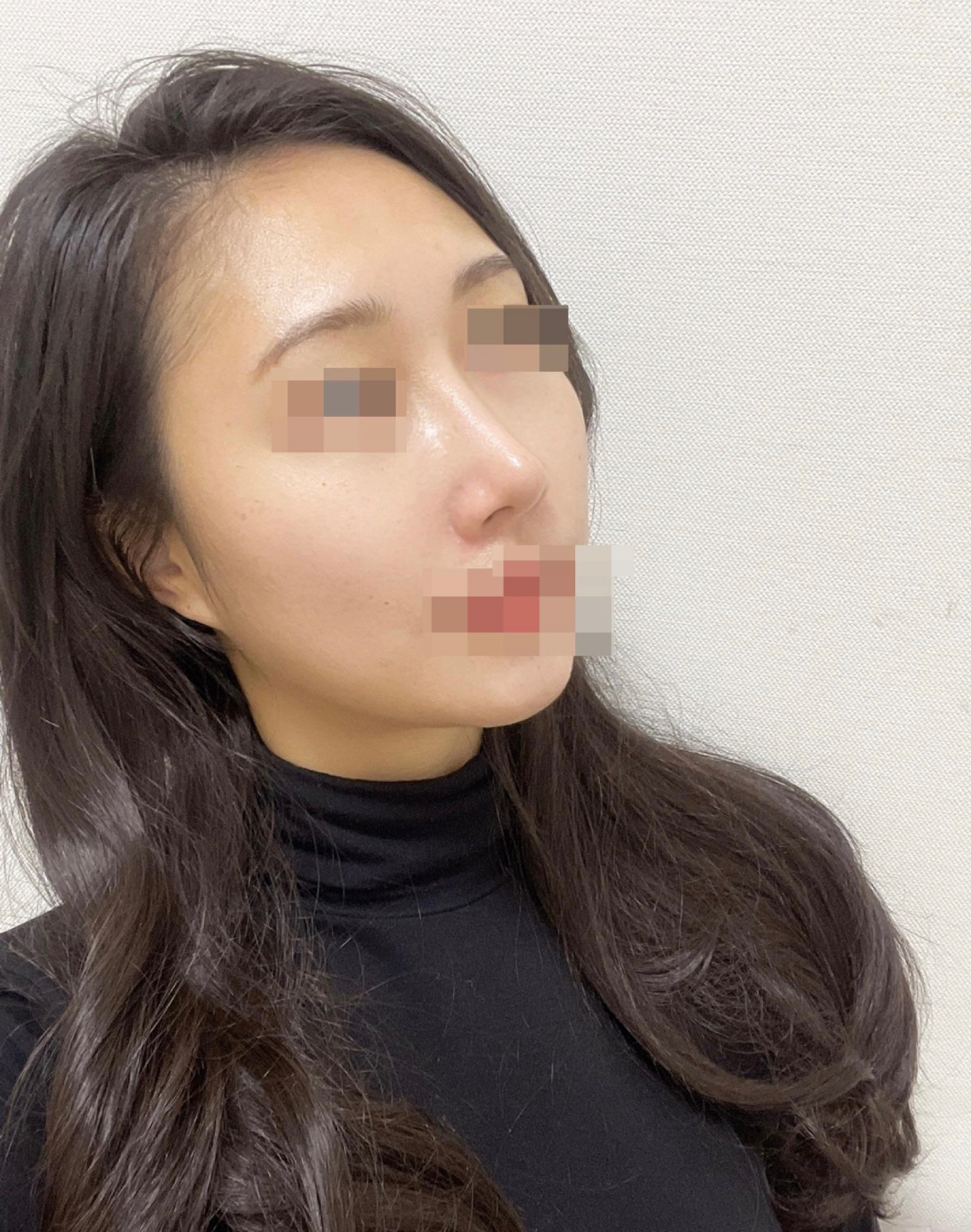 수술후기이미지