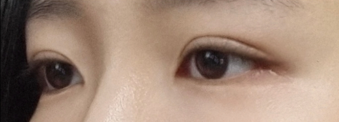 수술후기이미지