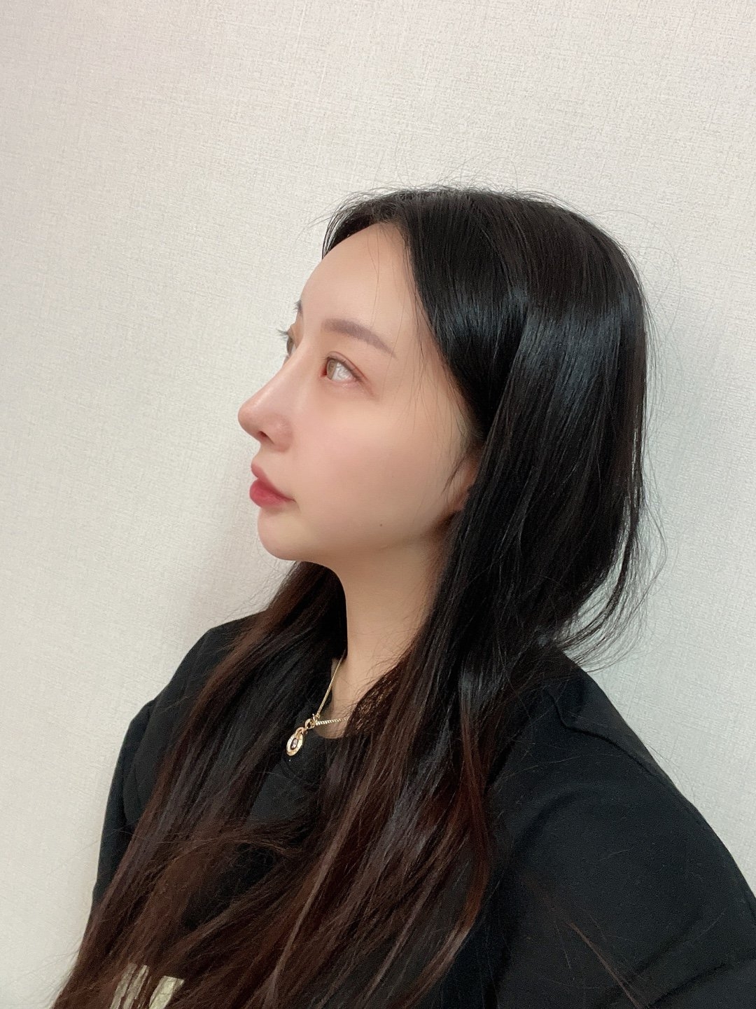 수술후기이미지