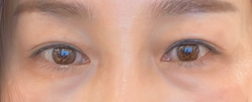 수술후기이미지