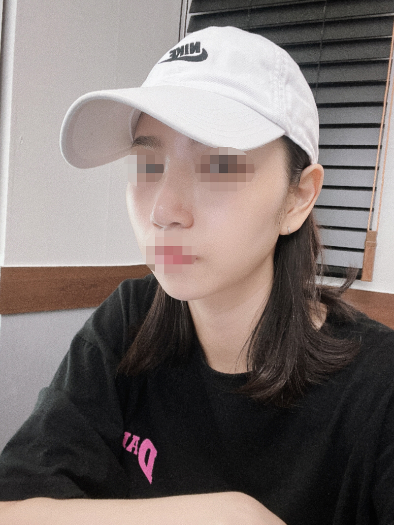 수술후기이미지