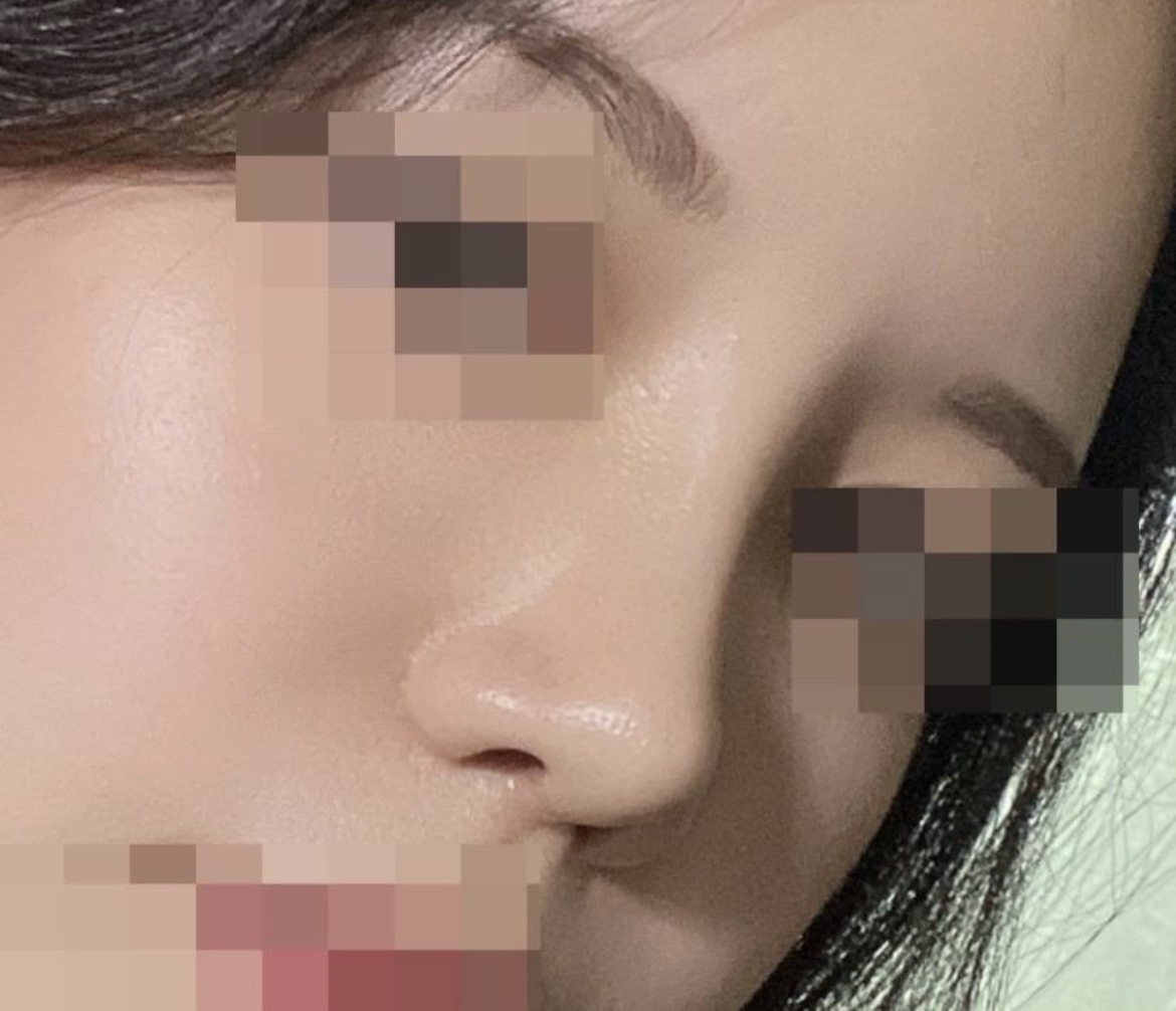 수술후기이미지