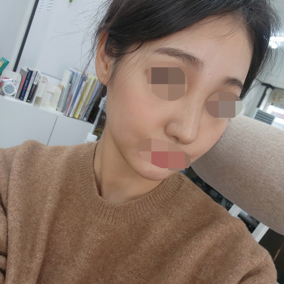 수술후기이미지