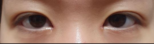 수술후기이미지