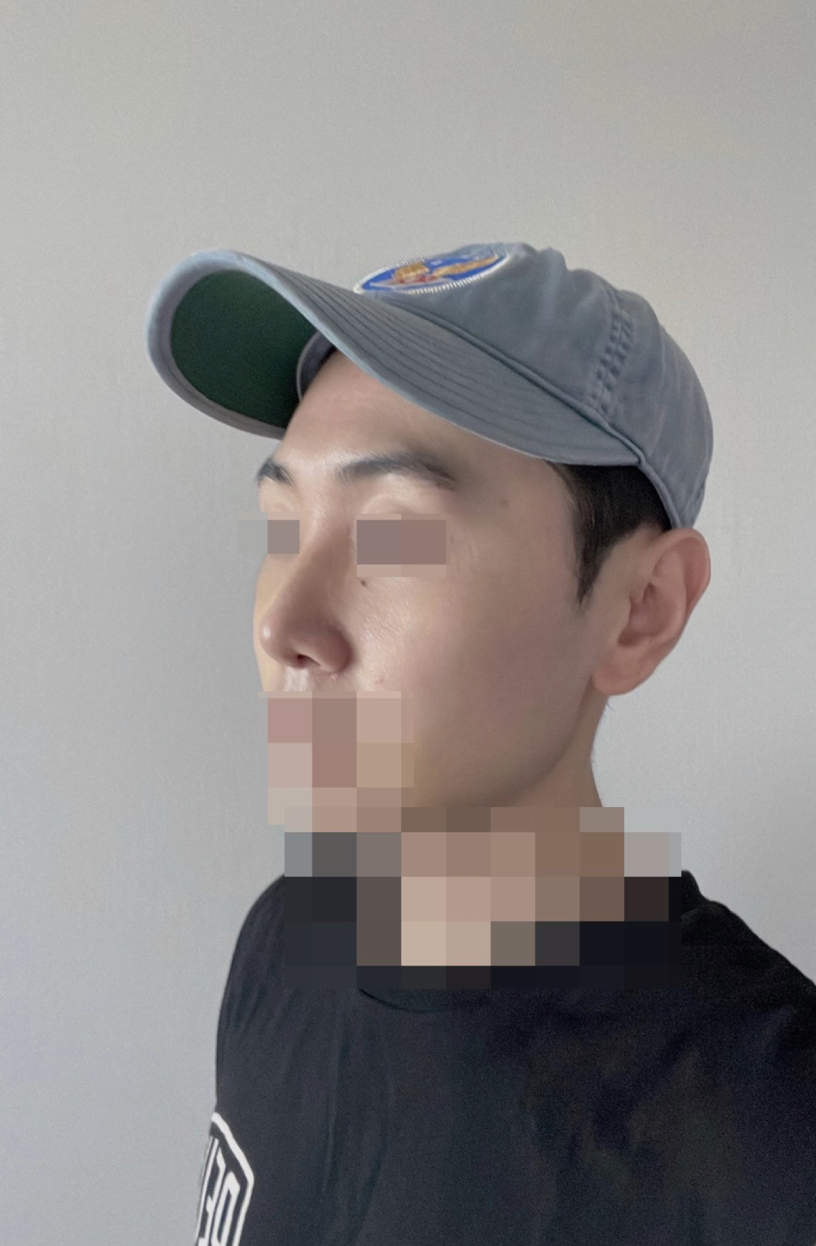 수술후기이미지