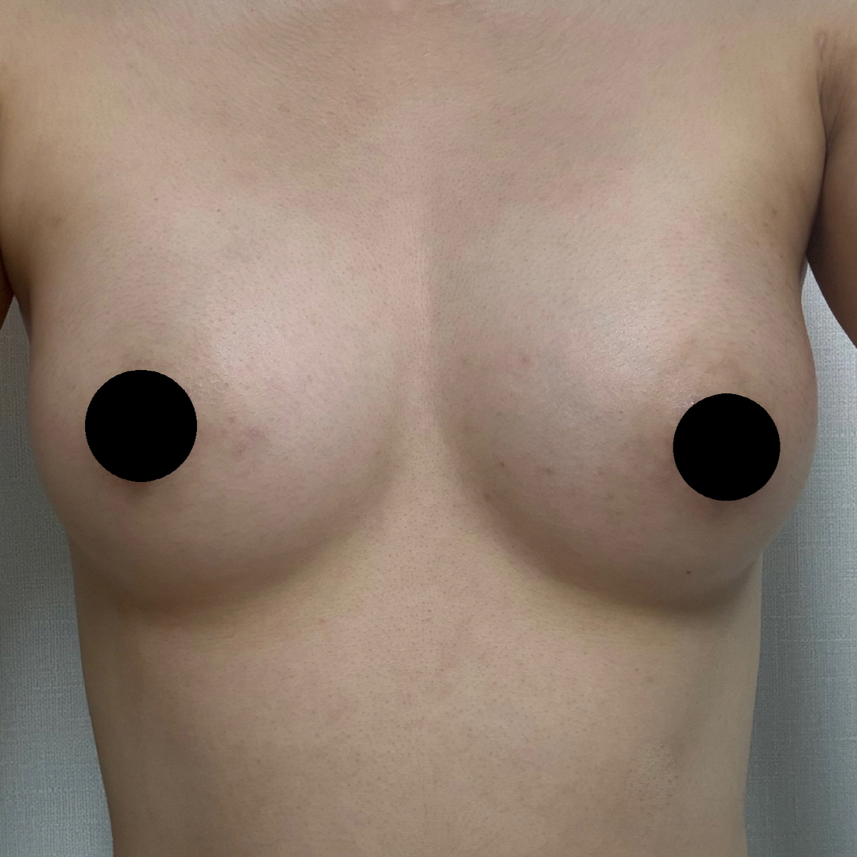 수술후기이미지