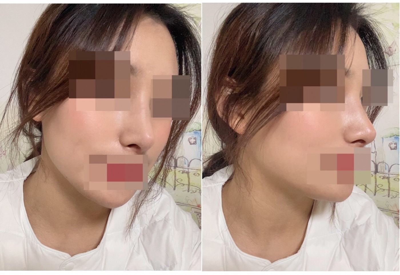 수술후기이미지