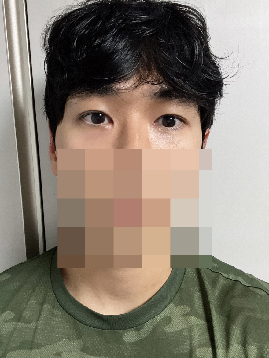 수술후기이미지