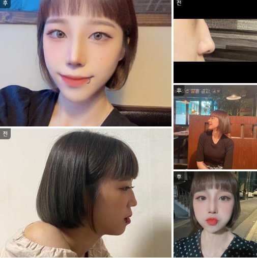 수술후기이미지